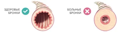 Захворювання дихальної системи види і особливості (системи) Захворювання дихальної системи види і особливості