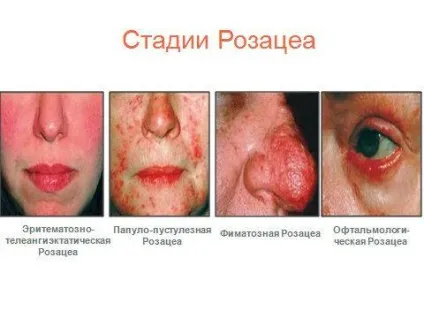 Захворювання шкіри обличчя (огляд поширених шкірних хвороб) (хвороб) Захворювання шкіри обличчя (огляд поширених шкірних хвороб)
