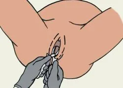 Акушерські щипці 1