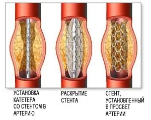 Атеросклероз сонних артерій - лікування серця (атеросклероз) Атеросклероз сонних артерій - лікування серця