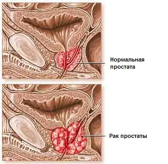 Болиголов і лікування раку, рак - лікування і профілактика (передміхурової залози головного) Болиголов і лікування раку, рак - лікування і профілактика