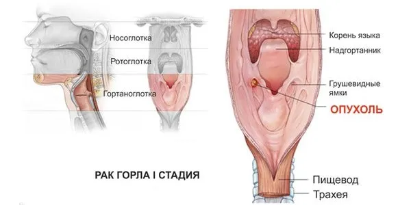 Біль при ковтанні в гортані які можуть бути захворювання і їх симптоми (ковтанні) Біль при ковтанні в гортані які можуть бути захворювання і їх симптоми