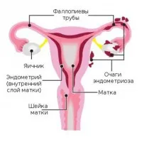 Борова матка лікувальні властивості і протипоказання в гінекології (ортилия однобока) (борова) Борова матка лікувальні властивості і протипоказання в гінекології (ортилия однобока)