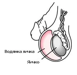 Часті питання по водянці яєчка, мій уролог (питання) Часті питання по водянці яєчка, мій уролог