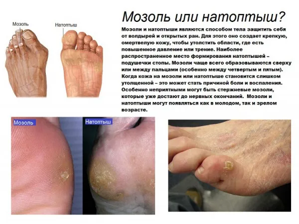Бородавки що це таке і як лікувати (бородавки) Бородавки що це таке і як лікувати