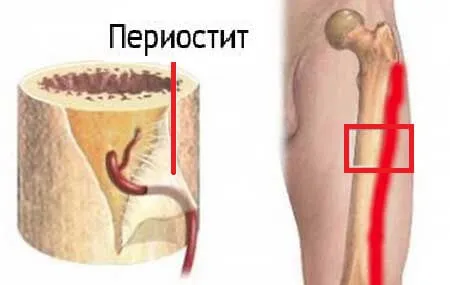 Чим небезпечний удар гомілки - 3 серйозних ускладнення, як лікувати (лікування забиття гомілки) Чим небезпечний удар гомілки - 3 серйозних ускладнення, як лікувати