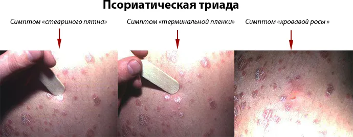 Чим відрізняється екзема від псоріазу (псоріазу) Чим відрізняється екзема від псоріазу