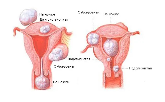 Що таке фіброміома матки (фіброміома) Що таке фіброміома матки