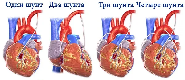 Що таке інфаркт серця і його особливості (серця) Що таке інфаркт серця і його особливості
