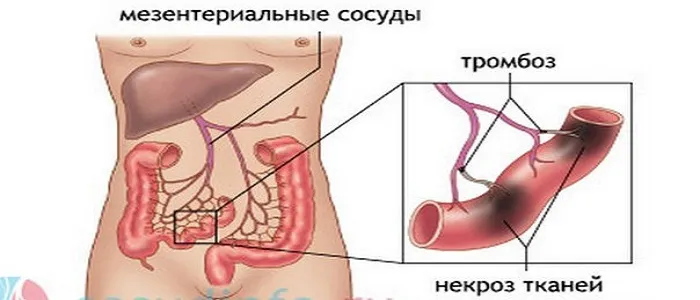 Що таке інфаркт серця і його особливості (серця інфаркт міокарда) Що таке інфаркт серця і його особливості