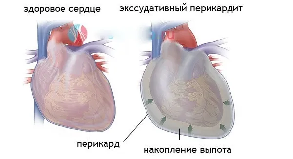 Ексудативний перикардит лікування, ознаки, причини, симптоми (ексудативний перикардит лікування) Ексудативний перикардит лікування, ознаки, причини, симптоми