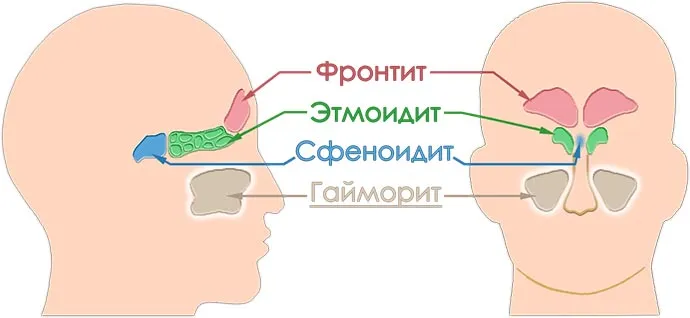 Гайморит, все про лікування, симптоми і методи профілактики (консервативних методів лікування) Гайморит, все про лікування, симптоми і методи профілактики