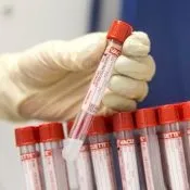 Харчування і дієта при вузловому зобі щитовидної залози (вузловому) Харчування і дієта при вузловому зобі щитовидної залози