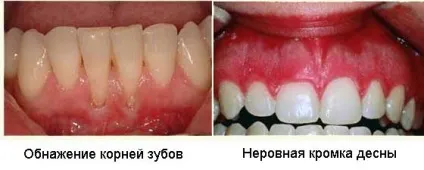 Пластика ясна - як проводиться клаптева операція на яснах (гінгівопластика) - стоматологічний (проводиться) Пластика ясна - як проводиться клаптева операція на яснах (гінгівопластика) - стоматологічний