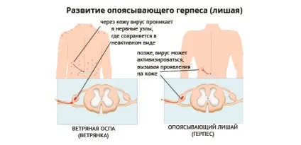Білі плями на спині після засмаги, лікування, грибок, як позбутися і шкірі (засмаги) Білі плями на спині після засмаги, лікування, грибок, як позбутися і шкірі
