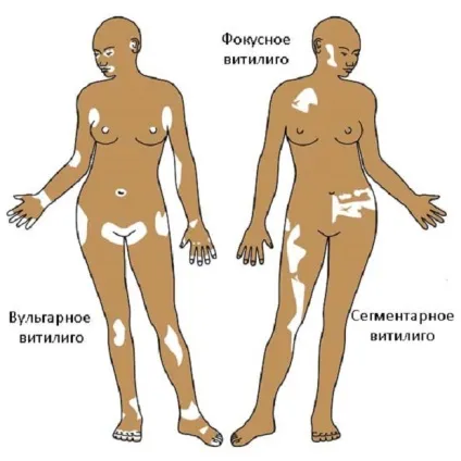 Білі плями на спині після засмаги, лікування, грибок, як позбутися і шкірі (білі) Білі плями на спині після засмаги, лікування, грибок, як позбутися і шкірі