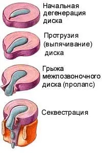Грижа - секвеструвати грижа хребта (хребта) Грижа - секвеструвати грижа хребта