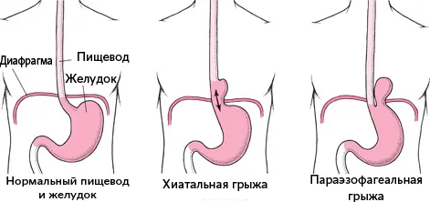 Грижа шлунка що це таке, як лікувати (лікувати) Грижа шлунка що це таке, як лікувати