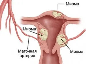 Інтрамуральна міома матки що це таке, діагностика, лікування (лікування) Інтрамуральна міома матки що це таке, діагностика, лікування