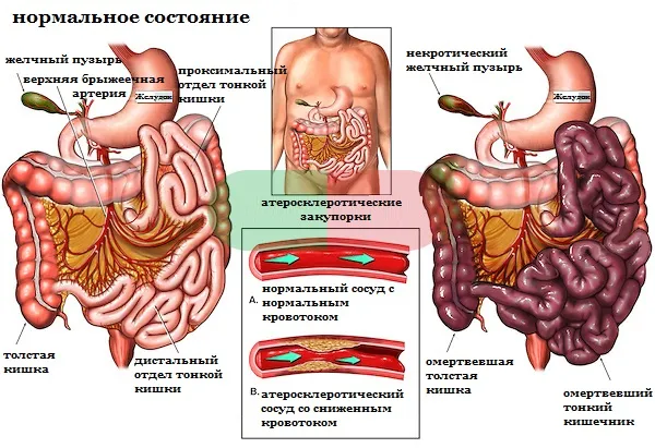 Ішемія кишечника симптоми, причини, діагностика та лікування недостатності кровообігу (причини) Ішемія кишечника симптоми, причини, діагностика та лікування недостатності кровообігу