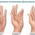 Як лікується костоеде, не хворій-ка (господарське мило) Як лікується костоеде, не хворій-ка