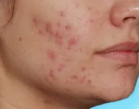 Як позбутися від почервоніння після прищів швидко і в домашніх умовах, давайте боротися з прищами (як позбутися від почервоніння після прищів в домашніх умовах) Як позбутися від почервоніння після прищів швидко і в домашніх умовах, давайте боротися з прищами