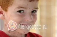 Як відрізнити алергію від вітрянки - алергія дитяча (алергія) Як відрізнити алергію від вітрянки - алергія дитяча
