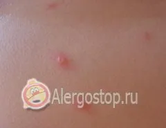 Як відрізнити алергію від вітрянки - алергія дитяча (алергія) Як відрізнити алергію від вітрянки - алергія дитяча