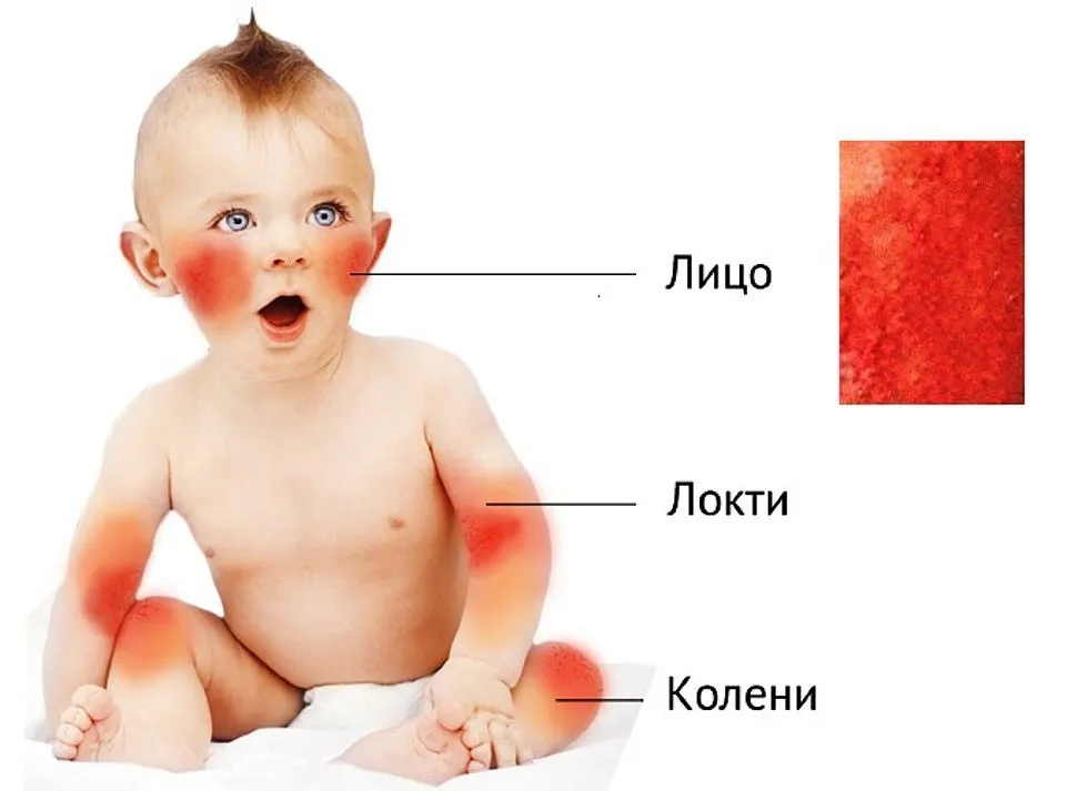 Як відрізнити пітницю від алергії у немовляти і дорослого (пітницю) Як відрізнити пітницю від алергії у немовляти і дорослого