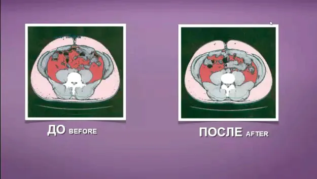 Як спалити вісцеральний жир на животі () Як спалити вісцеральний жир на животі