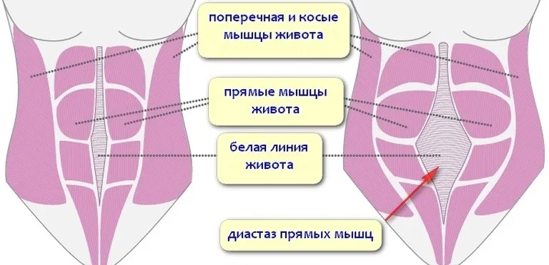 Як прибрати диастаз прямих м'язів живота (диастаз Кривий Ріг) Як прибрати диастаз прямих м'язів живота