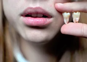 Кіста зуба що це таке, симптоми, лікування, фото (фото) Кіста зуба що це таке, симптоми, лікування, фото