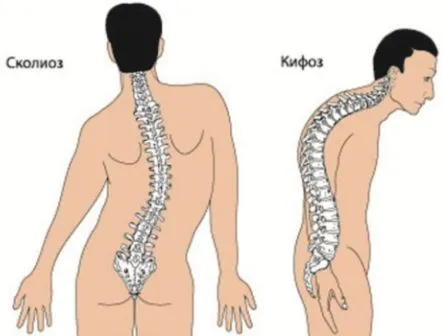 Кіфотична і кіфосколіотіческая постава що це таке, як виявляється (кифотическая) Кіфотична і кіфосколіотіческая постава що це таке, як виявляється