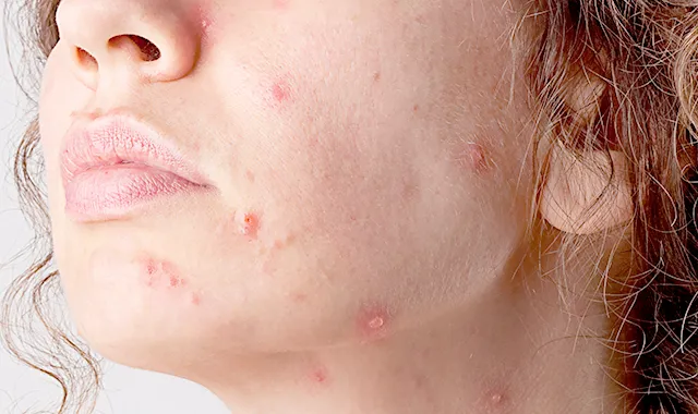 Кератоз шкіри на обличчі симптоми і методи лікування (методи) Кератоз шкіри на обличчі симптоми і методи лікування
