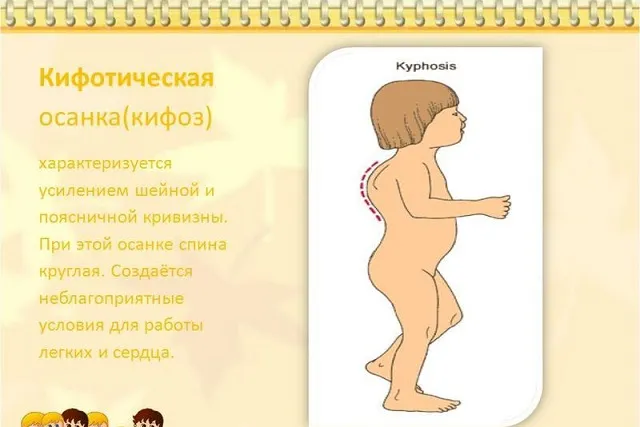 Кіфотична і кіфосколіотіческая постава як лікувати порушення і що можна зробити (можна) Кіфотична і кіфосколіотіческая постава як лікувати порушення і що можна зробити