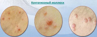 Контагіозний молюск лікування лазером і народними засобами (лазером) Контагіозний молюск лікування лазером і народними засобами