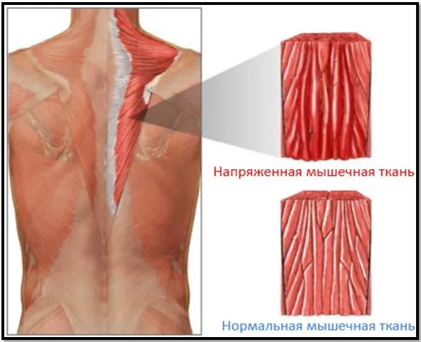крепатура м'язів
