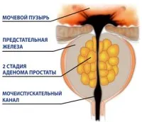 Лікування аденоми простати консервативна терапія і операція (терапія) Лікування аденоми простати консервативна терапія і операція