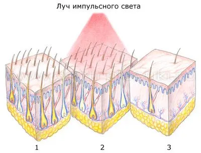 Квантова епіляція - що це таке, ціни, відгуки, протипоказання, фото до і після, відео