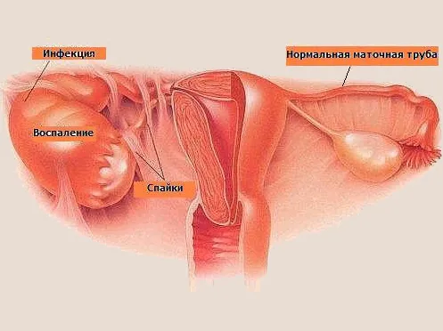 лікування гидросальпинкса