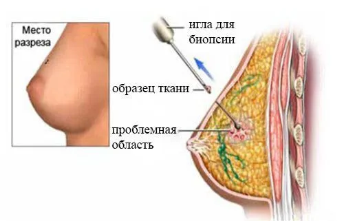 Лікування фіброаденоми молочної залози показання до видалення, можливість рецидивів