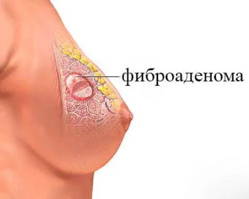 Лікування фіброаденоми молочної залози показання до видалення, можливість рецидивів