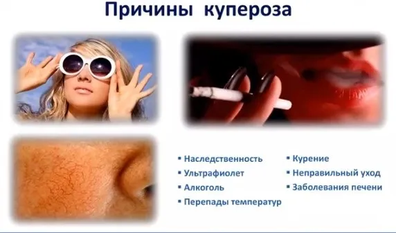 Купероз на обличчі фото, причини, як позбутися