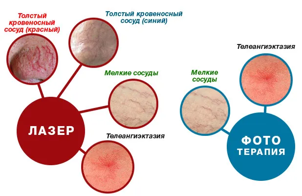 Купероз на обличчі фото, причини, як позбутися