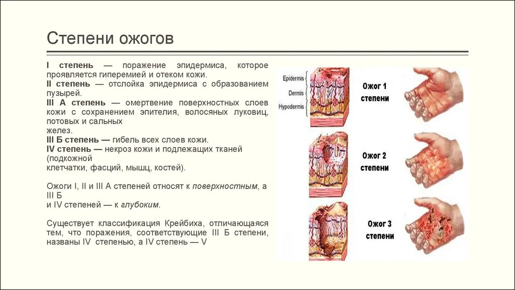 Мазь від опіків окропом (з пухирями) (опіків) Мазь від опіків окропом (з пухирями)