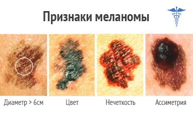 Меланома шкіри прогнози життя, симптоми і лікування (прогнози) Меланома шкіри прогнози життя, симптоми і лікування