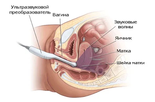 М-ехо матки і шийки матки норма, показники, розшифровка (м-відлуння) М-ехо матки і шийки матки норма, показники, розшифровка