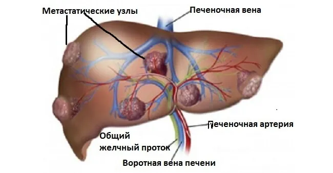 Метастази в печінці симптоми і лікування, прогноз терміну життя (прогноз) Метастази в печінці симптоми і лікування, прогноз терміну життя