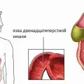 Народне лікування виразки стравоходу (виразки) Народне лікування виразки стравоходу