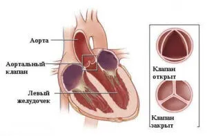 Недостатність аортального клапана 2 причини, ознаки, лікування (лікування) Недостатність аортального клапана 2 причини, ознаки, лікування